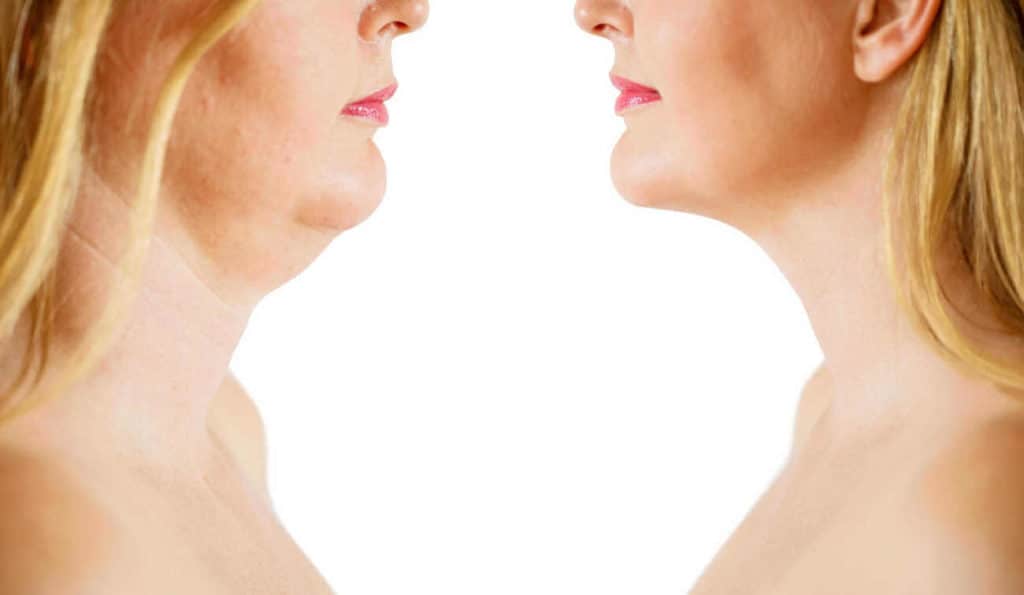 Double Chin treatment ENGLAND before and after results