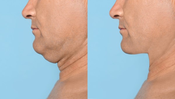 Which Non-Surgical Treatments Work Best for Jowls and Loose Skin ENGLAND?