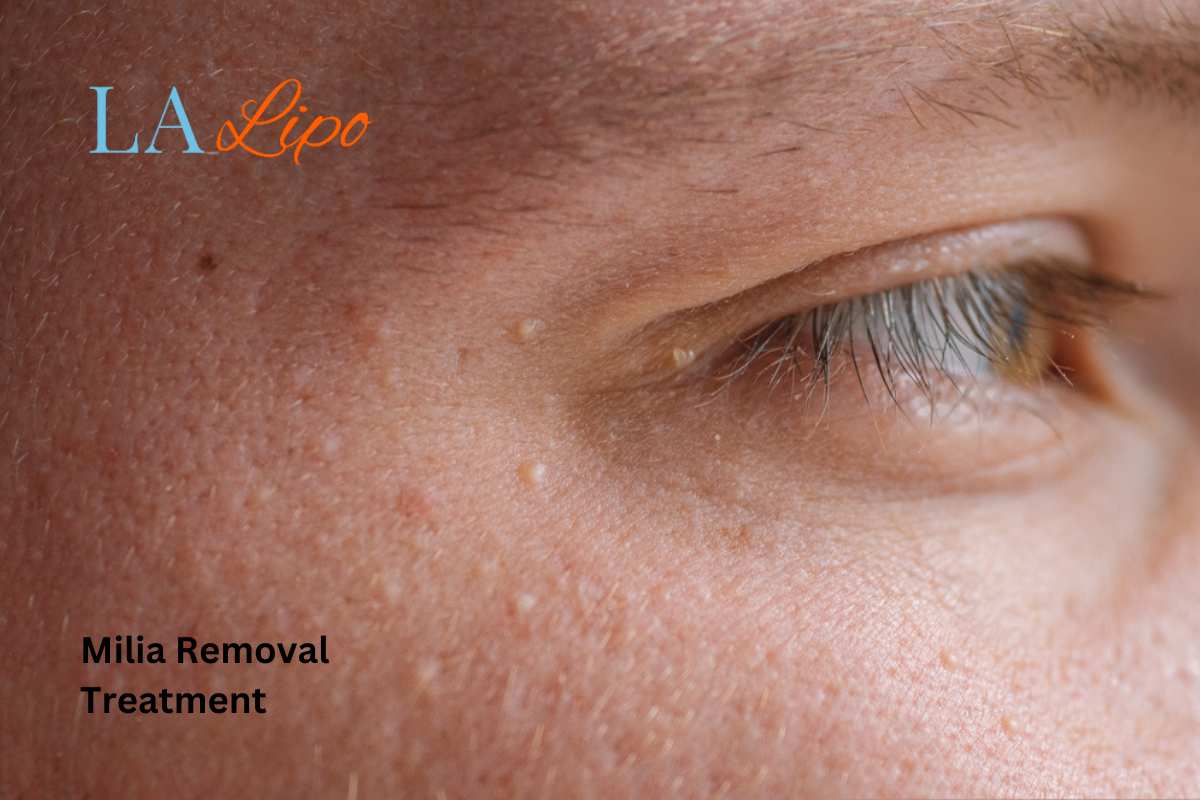 Cryopen Milia Removal: Is It the Easiest and Safest Option ENGLAND?