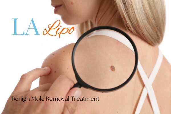 Why getting moles removed ENGLAND can boost your confidence!