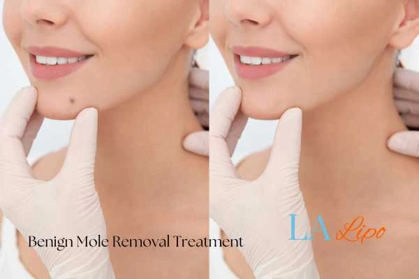 woman's before and after mole removal ENGLAND results