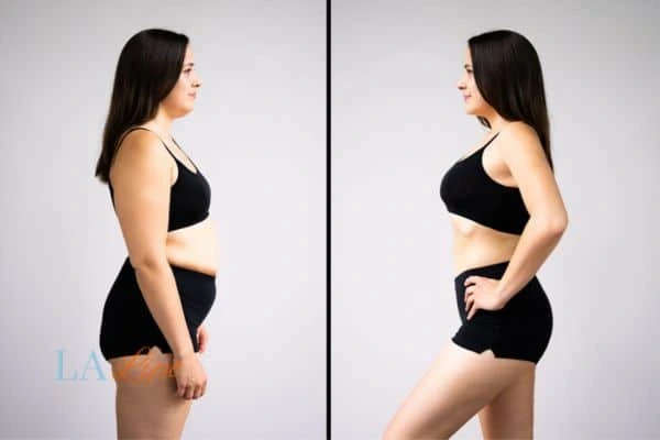 image of woman before and after results of LA-EMS Body Sculpting ENGLAND to help treat Diastasis recti