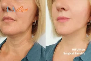 hi-fu for wrinkles ENGLAND before and after results