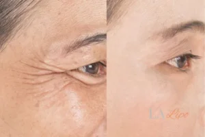 Before and after results of woman - HI-fu wrinkles reduction treatment ENGLAND