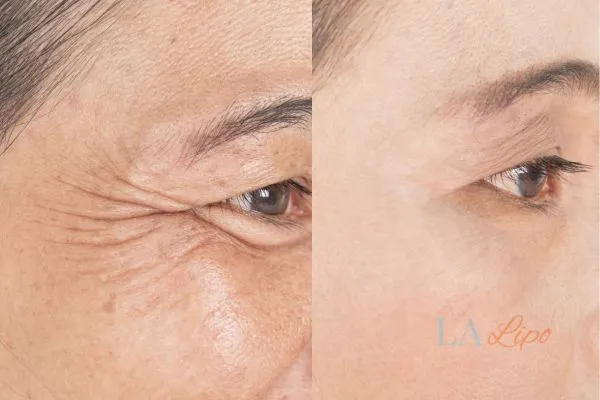 Before and after results of woman - HI-fu wrinkles reduction treatment ENGLAND
