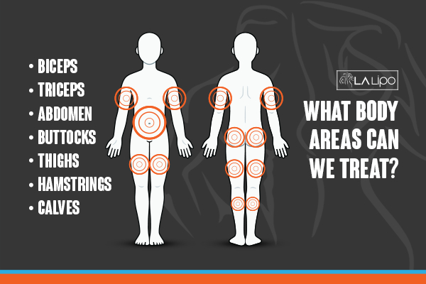 Graphic to show areas you can have LA-EMS Body Sculpting ENGLAND treatment.
