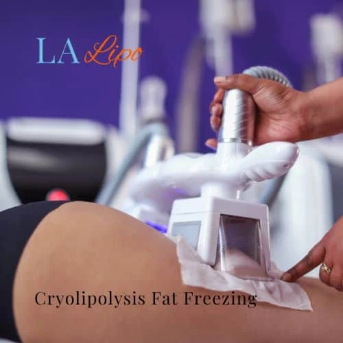 fat freezing - Cryolipolysis ENGLAND