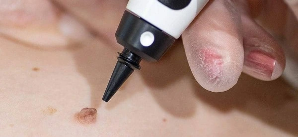 skin tag removal using cryopen ENGLAND