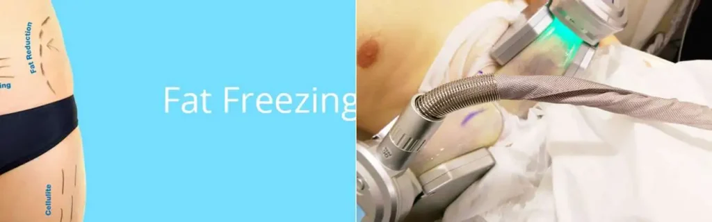 Fat freezing ENGLAND on multiple areas of the body