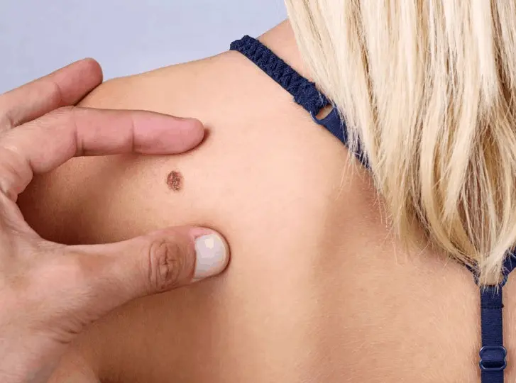 woman having mole removal ENGLAND consultation before treatment.