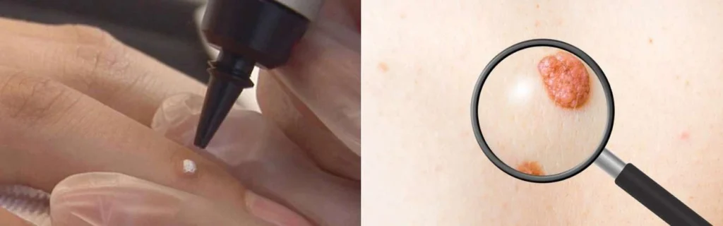 Person getting moles removed with cryopen ENGLAND