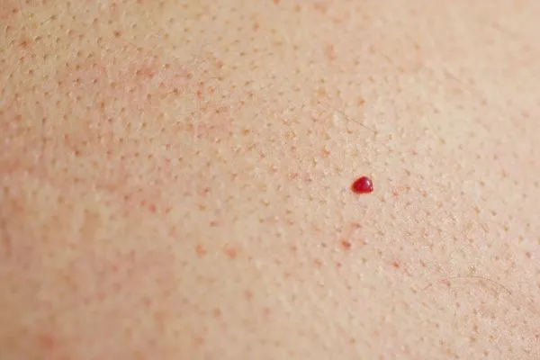 close up of a cherry angioma ENGLAND