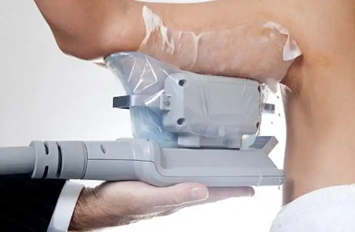 Picture of fat freezing ENGLAND on the upper arms.