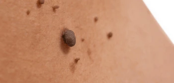 image of a skin tag ENGLAND