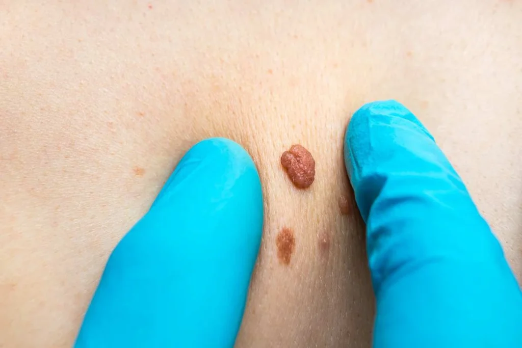 Consultant examining a skin tag ENGLAND