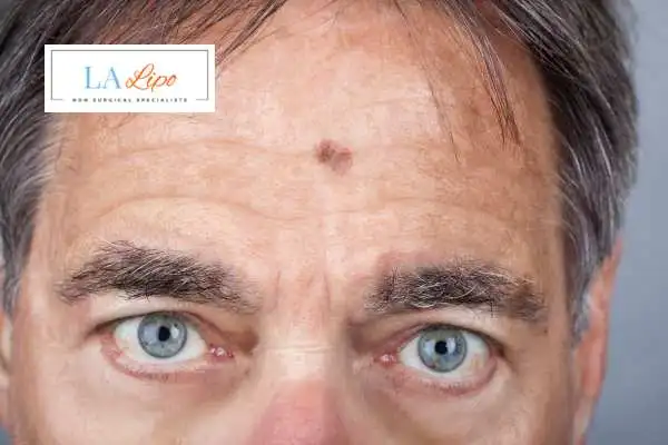 Solar Lentigo Removal ENGLAND image of man with mark on his forehead