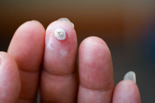 wart on person finger - cryotherapy to treat from LA LIPO ENGLAND