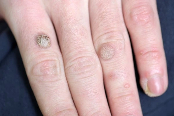 photo of warts on person hand - see wart removal ENGLAND from LA LIPO
