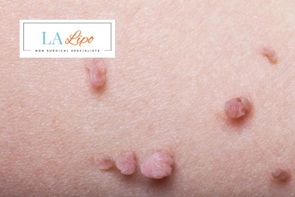 Does cryopen skin tag removal ENGLAND hurt? Find out now call our team today!