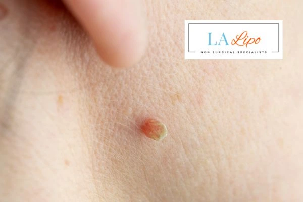 Book skin tag removal ENGLAND today speak to our team now!