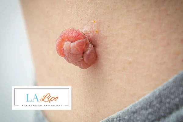 Interested in skin tag removal ENGLAND? Concerned about the pain? Find out more today!