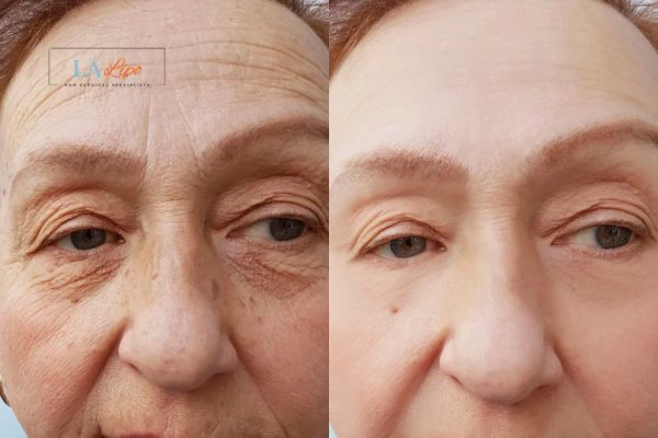 The powerful benefits of Morpheus8 Treatment ENGLAND - Call Our team today!