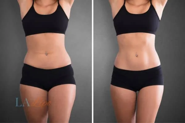before and after results of non-surgical treatment to help a woman's body image and mental health ENGLAND