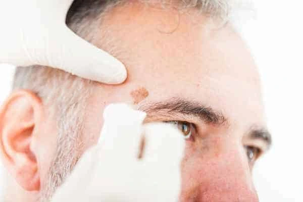 Age spots and elderly people ENGLAND what is the link?