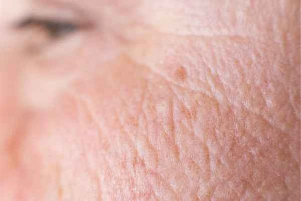 close up picture of a woman's face showing an age spot ENGLAND