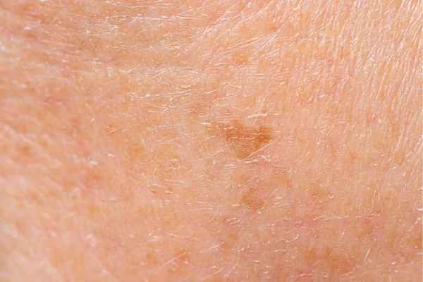 close up picture of age spots ENGLAND