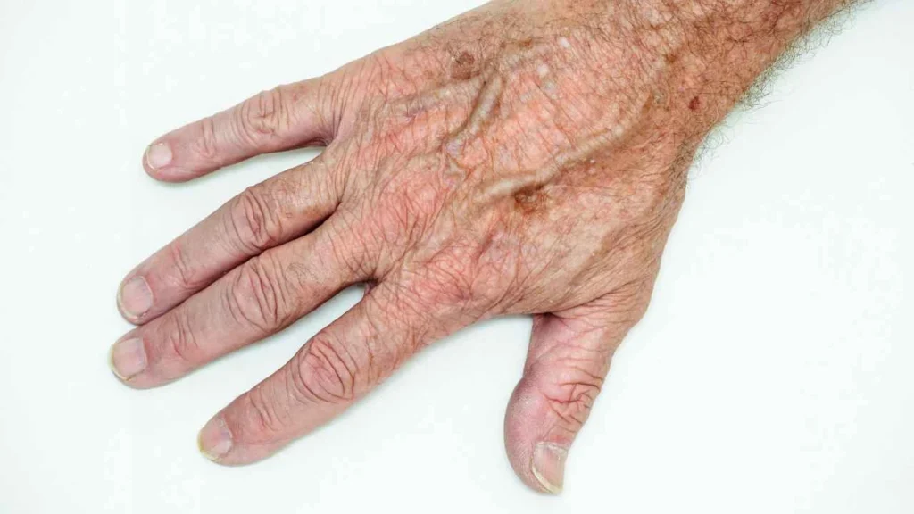 Male hand showing age spot ENGLAND