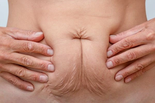 Should I Combine Diastasis Recti Treatment with Body Contouring for Better Results ENGLAND?