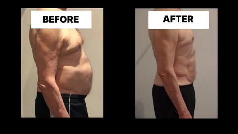 What Symptoms Can Diastasis Recti Cause in Men? Weak Core, Back Pain and Poor Posture ENGLAND